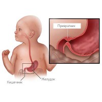 rvota-ф-grudnichka-pilorostenoz