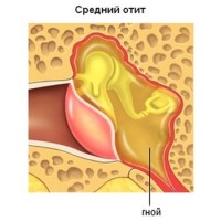 Схематично представяне на отит на средното ухо