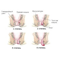 Схемата показва 4 степени на хемороиди