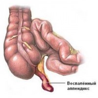 Фигурата показва възпаление на апендикса
