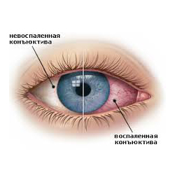 Фигурата показва симптомите на конюнктивит