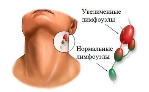 Целеви лимфни възли - норма и възпаление