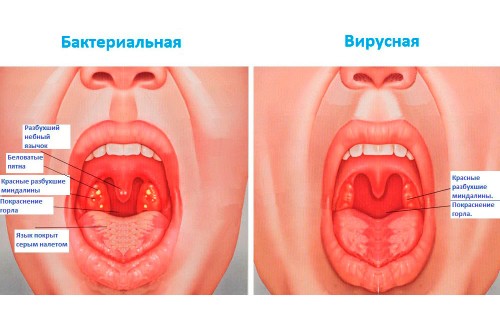 Видове ангина