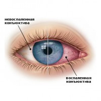 Фигурата показва конюнктивит