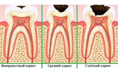 Етапи на образуване на кариес