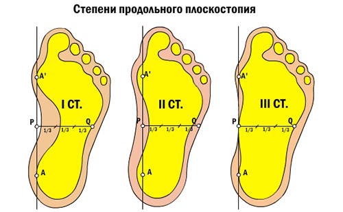 Фигурата показва тежестта на заболяването