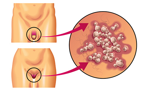Генитален херпес на снимката